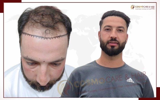 Before hair transplant, receding hairline